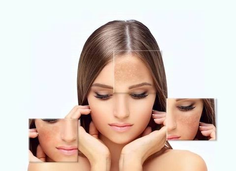 Explore Advanced Melasma Reduction With Skin Care Methods and Treatment Details